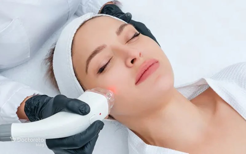 لیزر موهای زائد